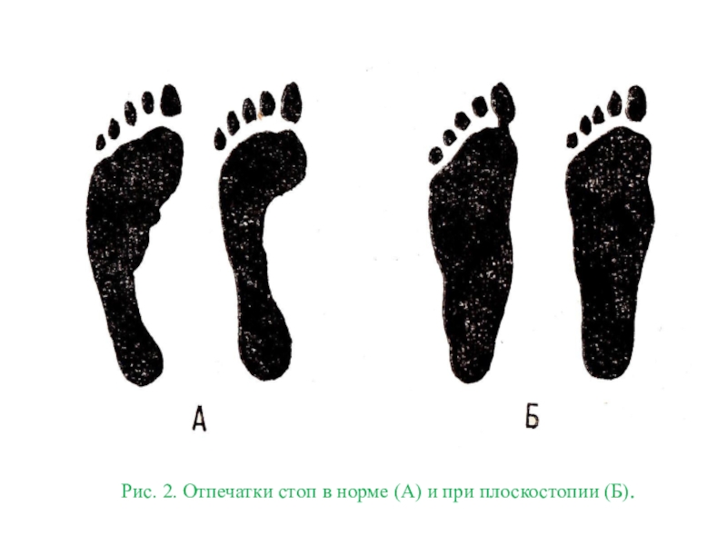 Следы 2 5. Плоскостопие отпечаток. Отпечаток нормальной стопы. Плоскостопие отпечаток стопы. Отпечаток ноги без плоскостопия.