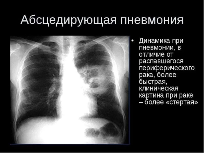 Рентген картина пневмонии