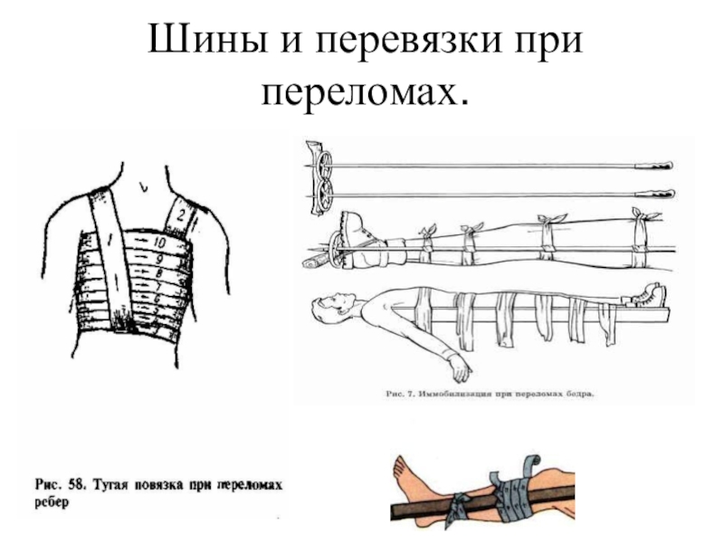 Шина при переломе. Схема накладывания шины при переломе. Перевязки при переломах. Шинные перевязки при переломе. Перевязка при переломе ноги.