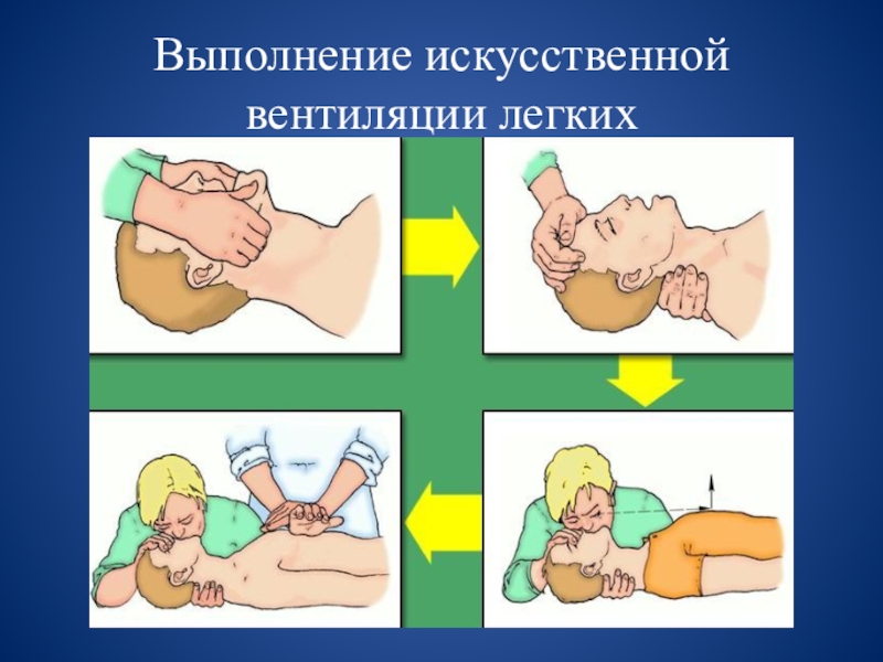 Мероприятия при проведении ивл. ИВЛ техника проведения. Алгоритм проведения искусственной вентиляции легких. Искусственная вентиляция легких ОБЖ. Техника выполнения ИВЛ.