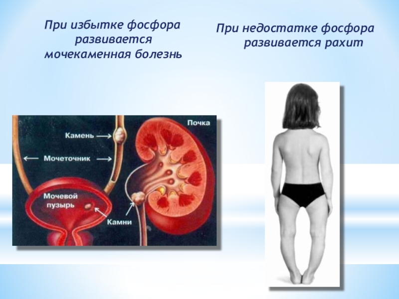 При избытке фосфора развивается мочекаменная болезньПри недостатке фосфора развивается рахит