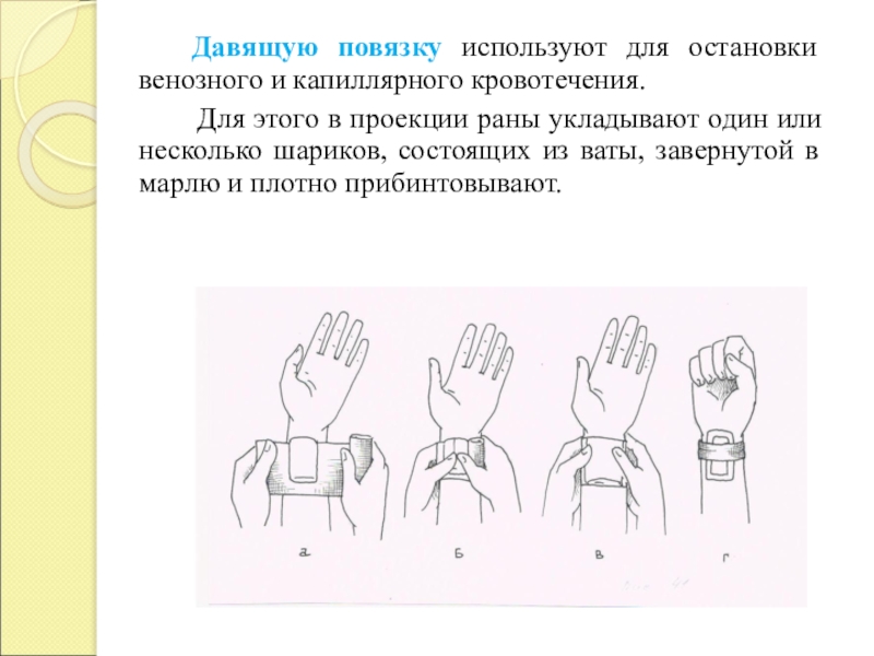 Наложение давящей повязки. Давящая повязка для остановки венозного кровотечения. Наложение давящей повязки при кровотечении. Наложение давящей повязки алгоритм.