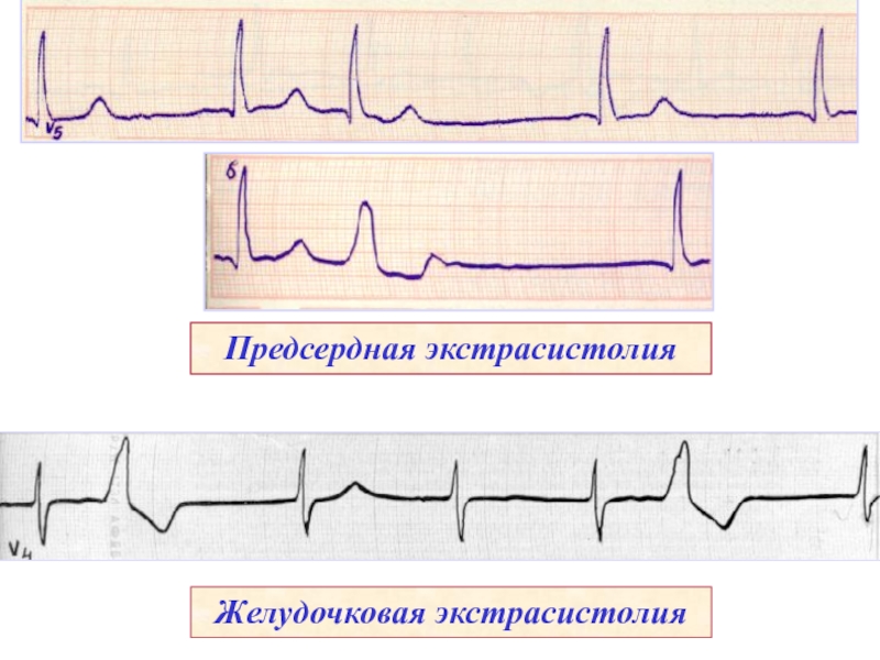 Предсердные экстрасистолы. Предсердные и желудочковые экстрасистолы. Экстрасистолия предсердий и желудочков. Предсердная и желудочковая экстрасистолия. Предсердная и желудочковая экстрасистолия на ЭКГ.