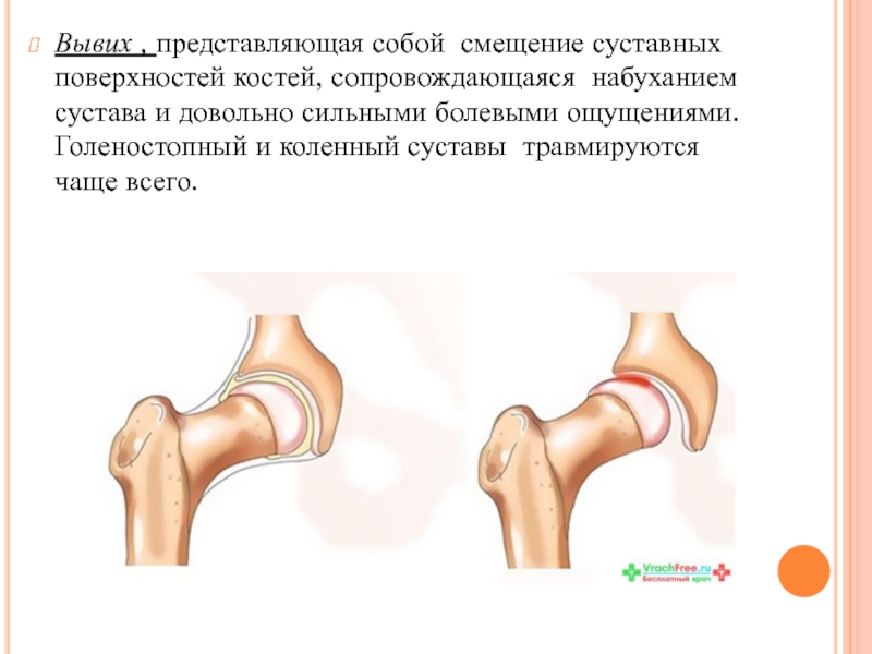 На рисунке изображена травма которая называется вывих сустава