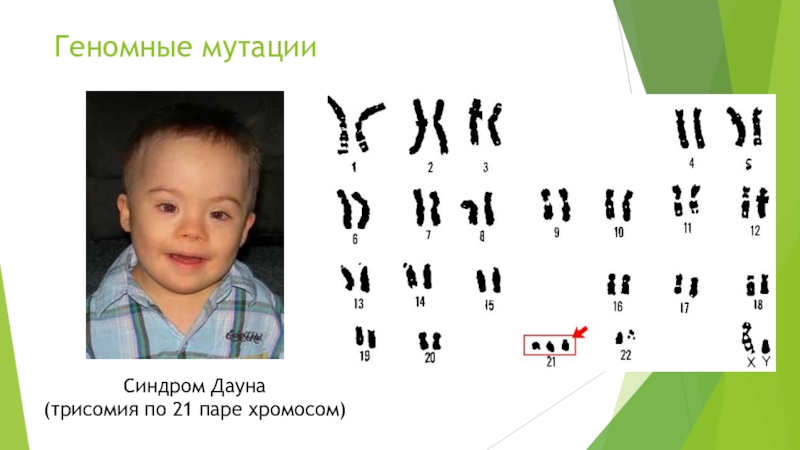 Форма изменчивости дауна. Синдром Дауна (трисомия по 21 паре хромосом). Синдром Дауна трисомия 21. Синдром Дауна трисомия 21 хромосомы. Синдром Дауна геномная мутация.