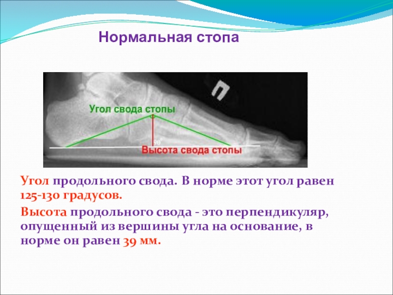 Нормальный угол. Угол продольного свода 125-130. Угол продольного свода стопы 160 градусов. Уголь продольного свода 1.28. Угол продольного свода стопы 3 степени.