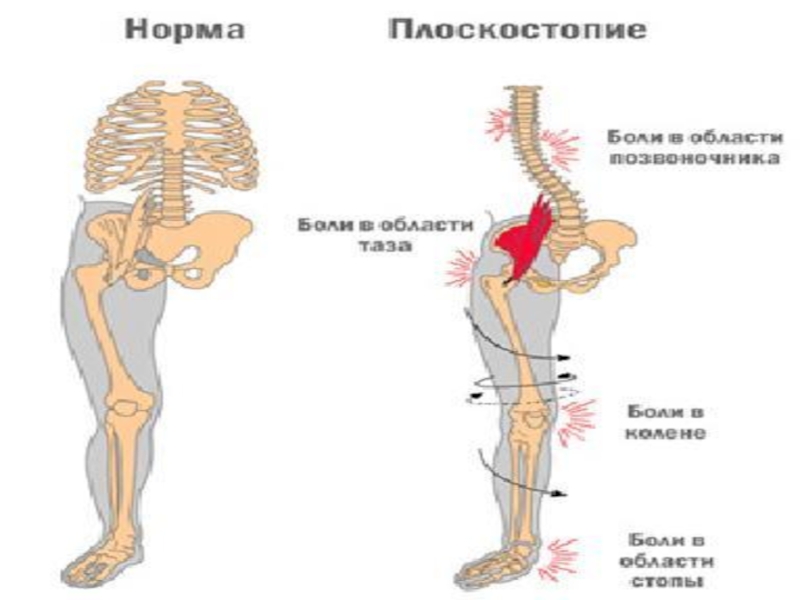 Физическая культура при плоскостопии презентация