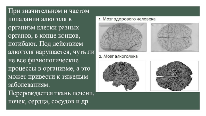 Мозг пьющего. Вскрытие головного мозга алкоголика. Мозг алкоголика вскрытие. Аутопсия мозга алкоголика. Мозг алкоголика и курильщика при вкрытие.