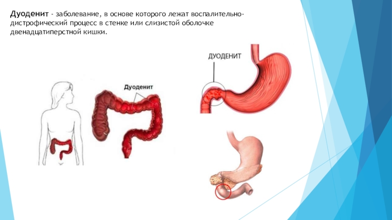 Воспаление двенадцатиперстной кишки. Дуоденит двенадцатиперстной кишки. Вторичный дуоденит желудка.