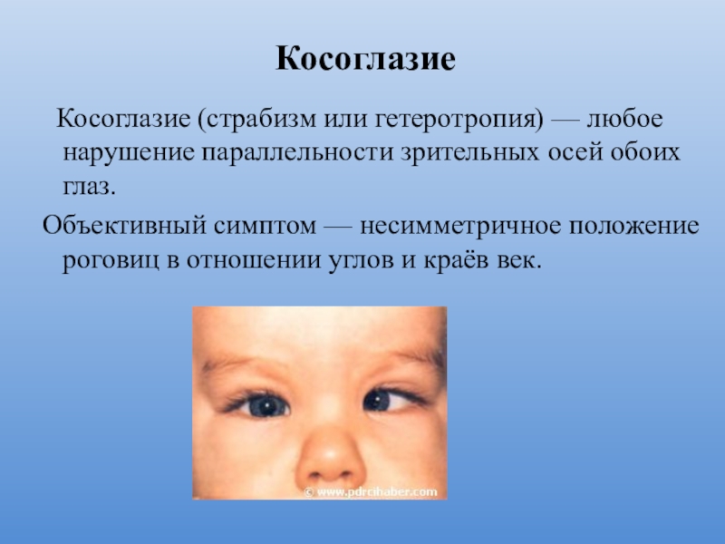 Заболевание и повреждение глаз биология 8 класс. Профилактика косоглазия. Предупреждение косоглазия. Косоглазие презентация. Косоглазие причины.