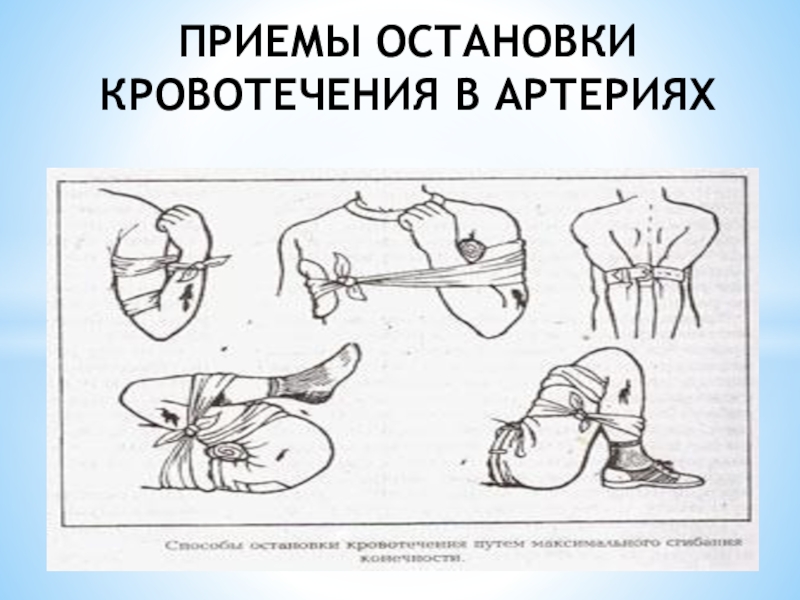 Остановка наружного кровотечения презентация