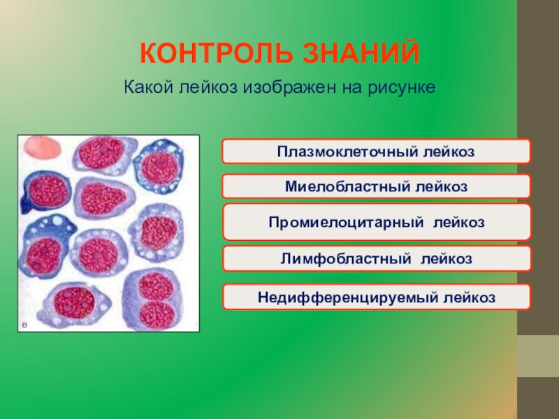 Болезни крови и кроветворных органов. Острый плазмоклеточный лейкоз. Картина крови при плазмоклеточном лейкозе. Острый плазмоклеточный лейкоз формулировка. Острый промиелоцитарный лейкоз.
