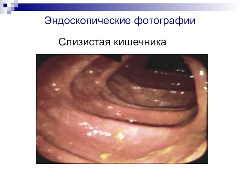 Эндоскопические фотографииСлизистая кишечника
