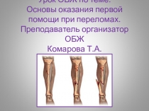 Презентация по ОБЖ Виды переломов, ПМП