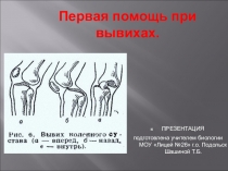Презентация по биологии на тему : Первая помощь при вывихах