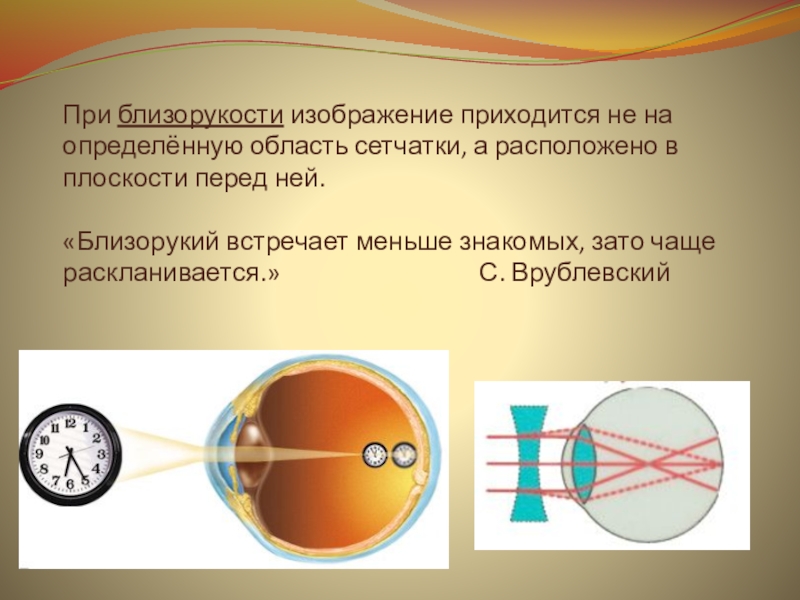 Изображение фокусируется перед сетчаткой