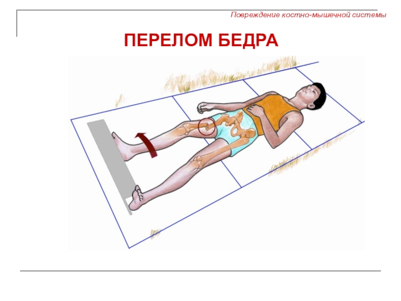 Повреждения опорно двигательного аппарата презентация