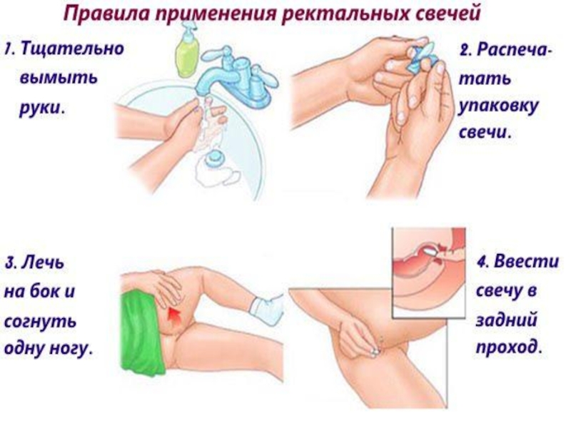 Как вводить суппозитории ректальные. Ректальный прием лекарств. Как правильно вводить свечку ректально. Как правильно вставлять свечку ректально. Введение суппозитория (свечи) в прямую кишку.