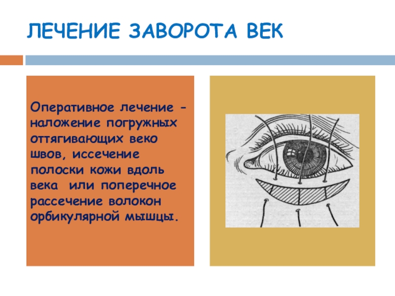 Веки описать. Техника операции при завороте век. Врожденный заворот Нижнего века.