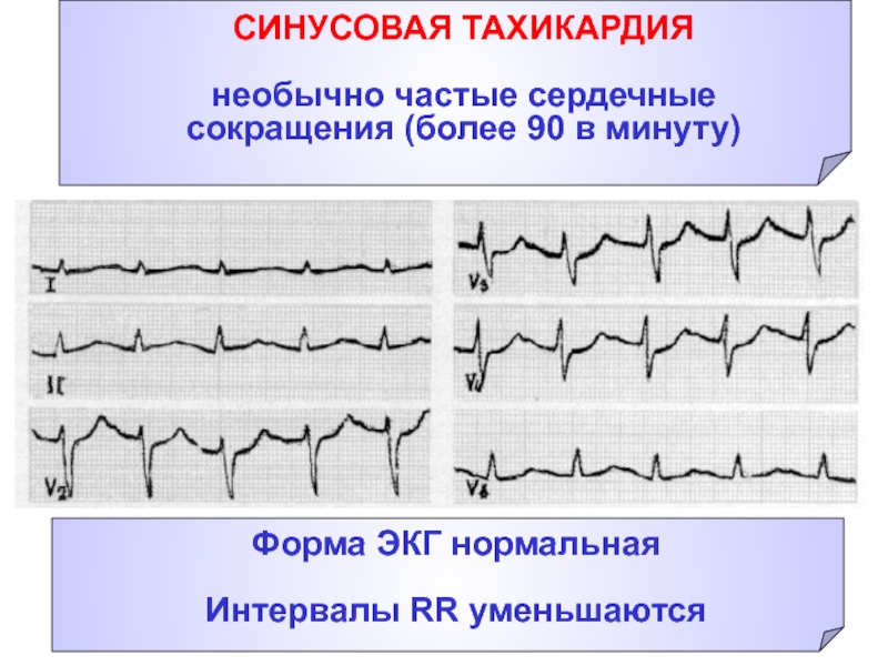 Синусовая тахикардия карта смп