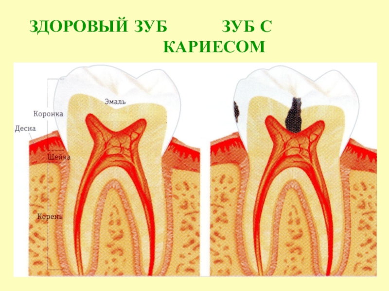 Кариес картинки для презентации