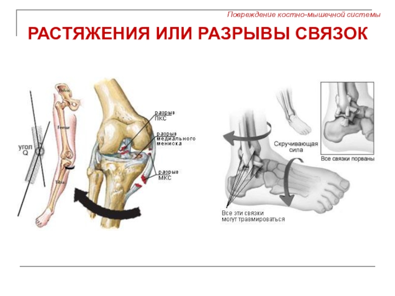 Повреждение связок. Растяжение или разрыв связок. Повреждение опорно двигательной системы. Травмы костно мышечной системы.