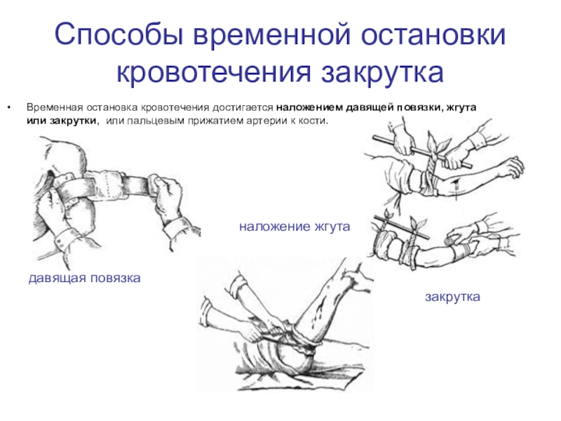 Способы остановки кровотечения презентация