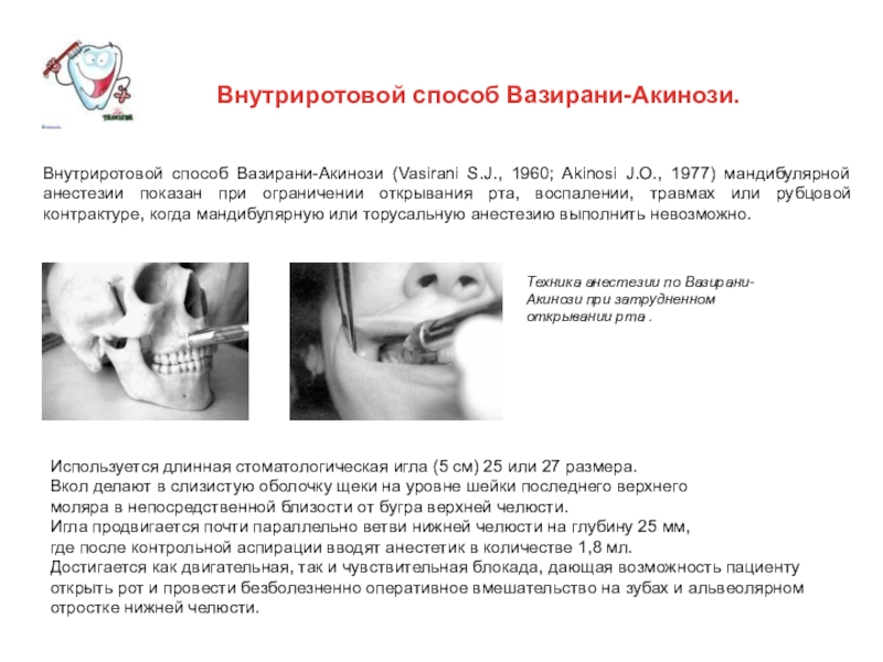 Мандибулярная анестезия и торусальная схема разница