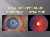 Презентация по сестринскому делу в офтальмологии на тему: Особенности диспансерного наблюдения за пациентами с глаукомой