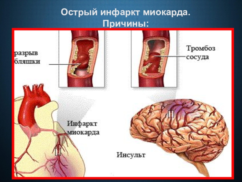 Инфаркт презентация обж