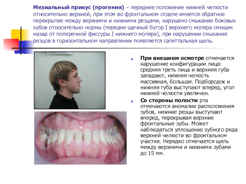 Прогения. Мезиальный прикус характеризуется. Нижняя прогнатия мезиальный прикус. Зубочелюстные аномалии мезиальный прикус. Аномалии прикуса прогнатия.