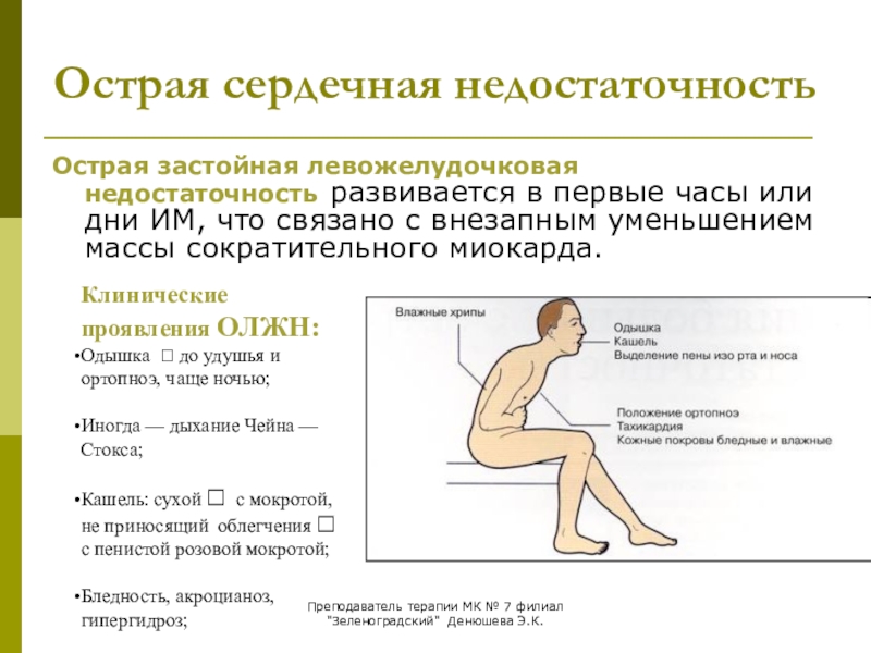 Острая сердечная недостаточность презентация