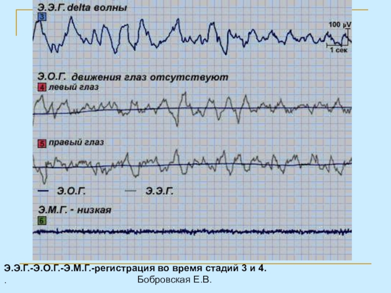 Дельта волны. Дельта волна. Дельта волны для сна. Быстрый сон Дельта волны. Наличие Дельта-волны.