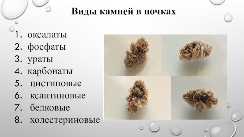 Ксантиновые камни в почках фото и описание