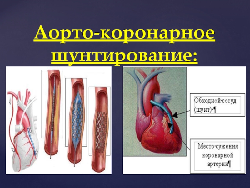 После шунтирования можно пить. Шунтирование коронарных артерий. Коронарное стентирование сосудов сердца. Аортокоронарное шунтирование (АКШ). Шунтирование сосудов сердца стент.