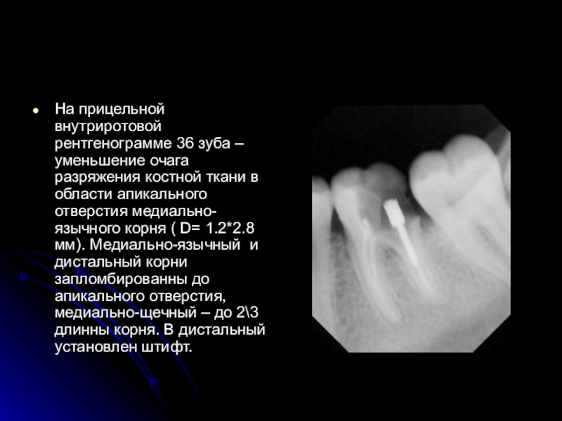 Разряжение костной ткани. Чтение внутриротовой контактной рентгенограммы. Очаг разряжения костной ткани полулунной формы. Описание рентгенограммы периодонтита зуба.