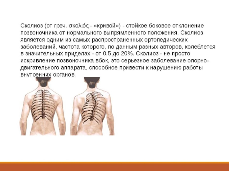 Массаж при сколиозе позвоночника презентация