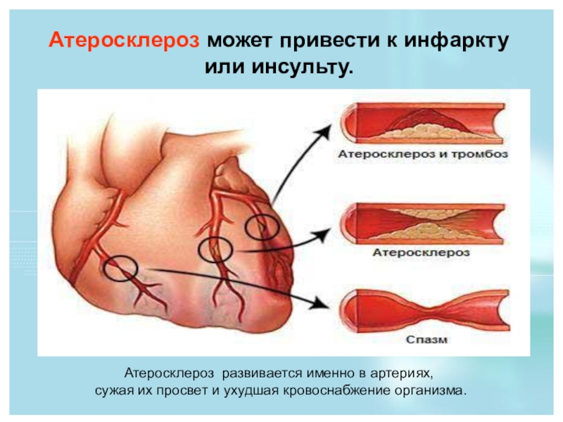 Презентация по теме атеросклероз