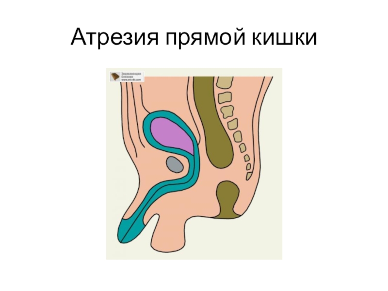 Атрезия заднего прохода и прямой кишки презентация