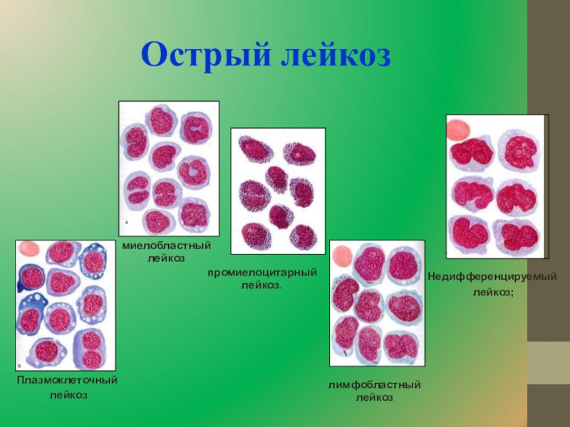 Острый лейкоз картина крови