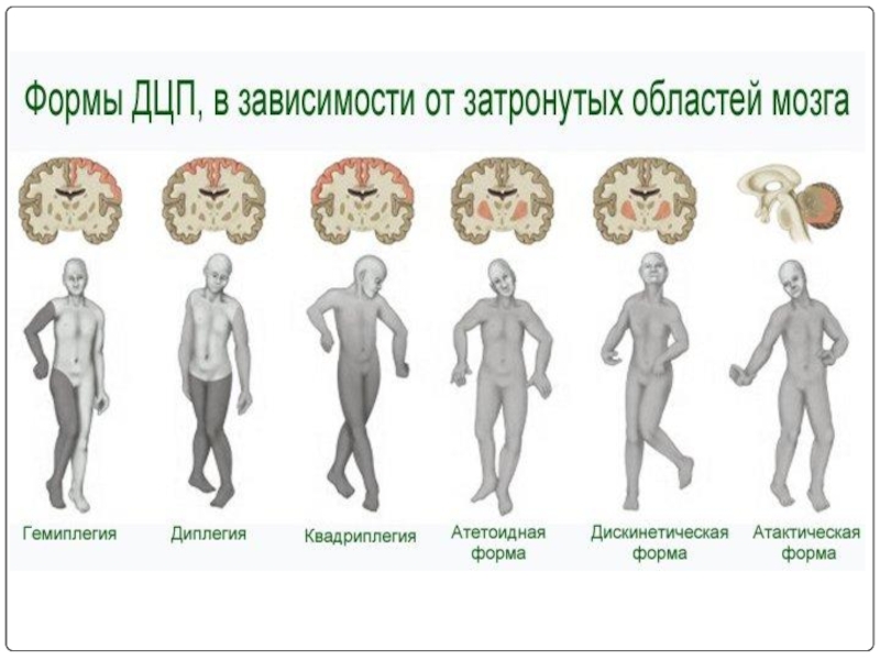 Дцп презентация неврология