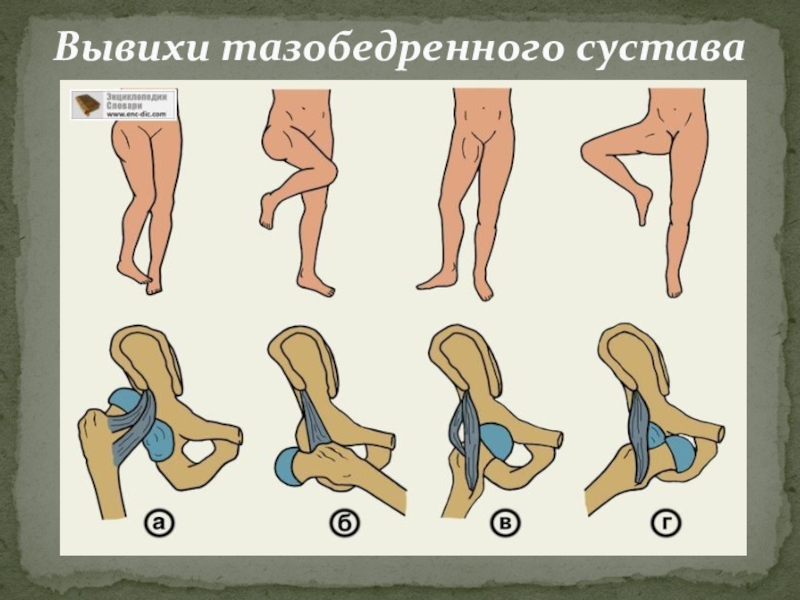 Растяжение связок тазобедренного сустава карта вызова