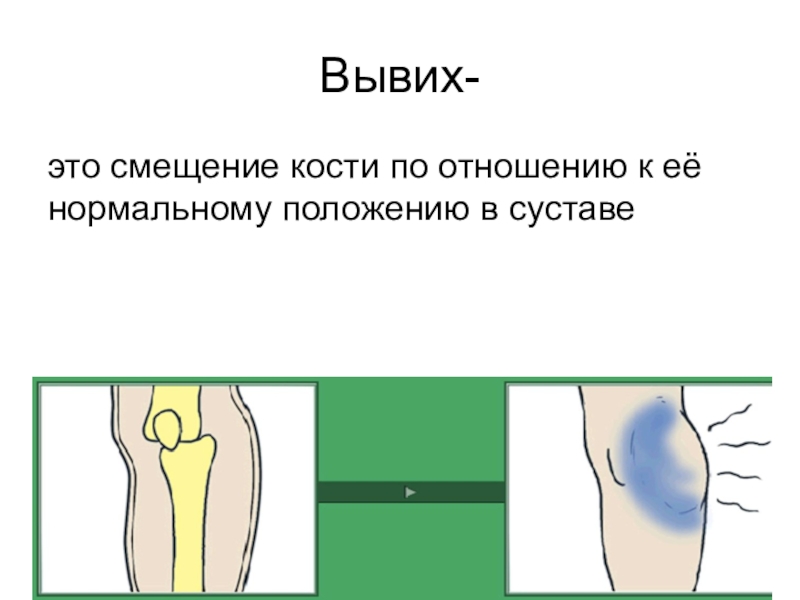 Смещение это. Смещение кости первая помощь. Смещение кости по отношению к ее нормальному положению в суставе это.