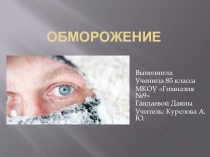 Презентация по биологии на тему ОБМОРОЖЕНИЕ