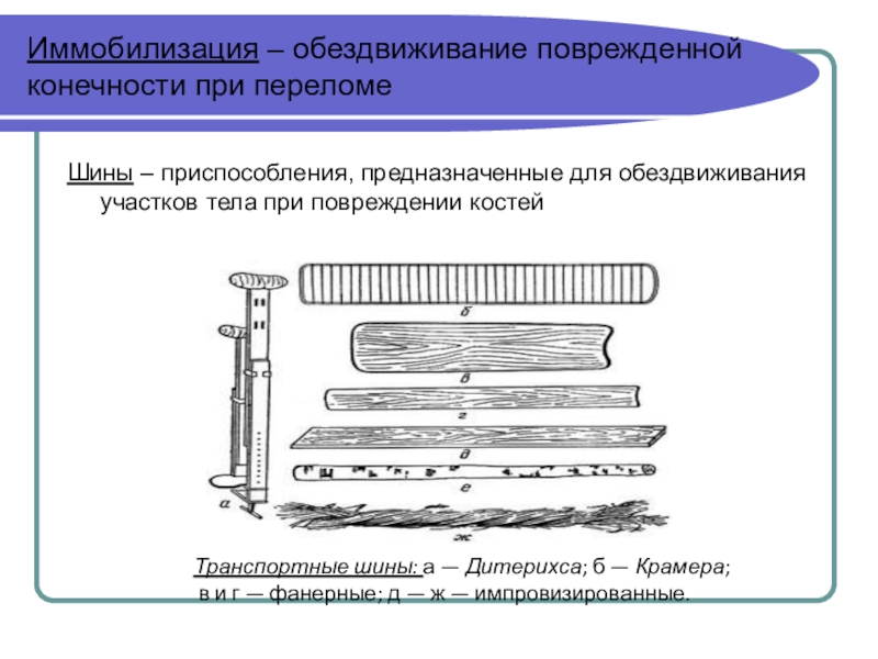 Система иммобилизации. Шины для иммобилизации. Иммобилизация конечности. Шины для иммобилизации конечностей виды. Иммобилизация поврежденной конечности.