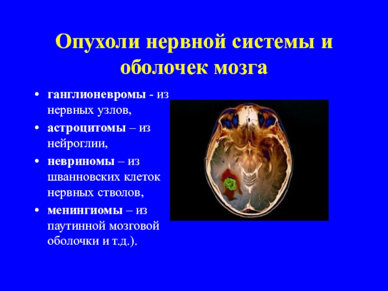 Опухоли нервной системы неврология презентация