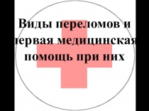 Презентация по ОБЖ на тему Виды переломов, первая медецинская помощь при переломах