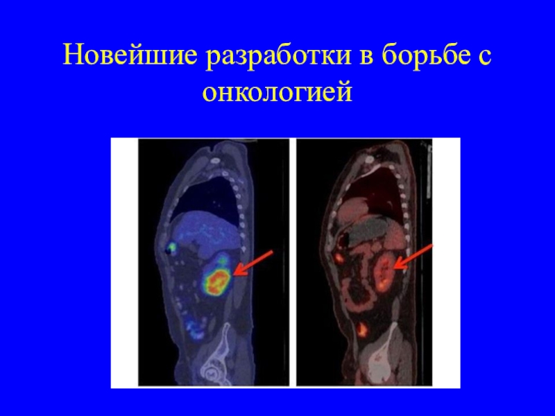 Презентация на тему опухоль