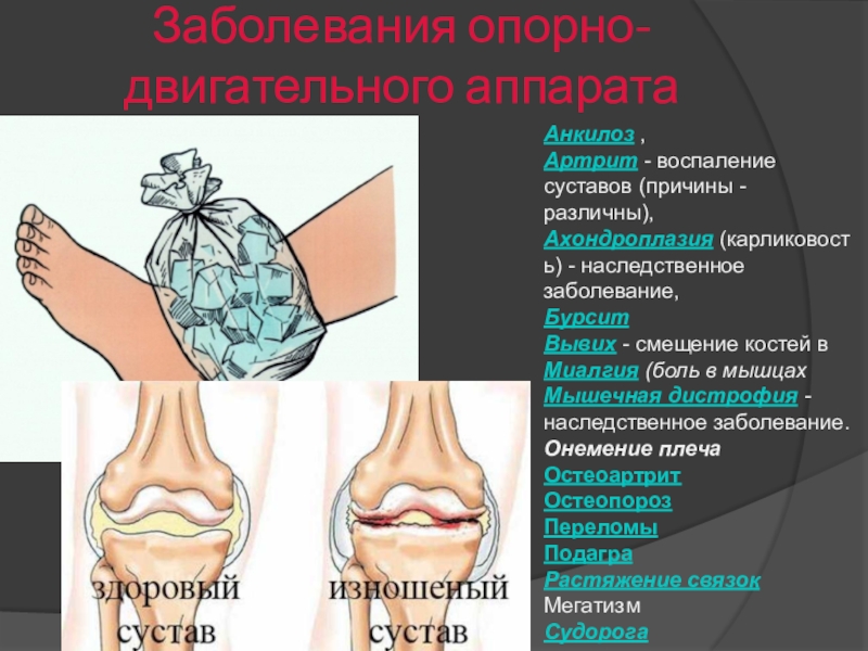 Анкилоз сустава. Наследственные заболевания опорно-двигательного аппарата. Анкилоз коленного сустава.