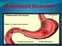 Презентация по биологии на тему: Язвенная болезнь